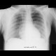 Pneumothorax, subcutaneous emphysema: X-ray - Plain radiograph
